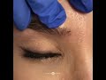 eyebrow lift using filler with jason emer md