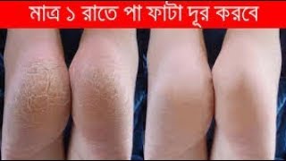 মাত্র ১ দিনে পা ফাটা  ও পায়ের গোড়ালি ফাটা   দূর করার উপায় /পা ফাটার ক্রিম Cracked Heels Cream