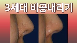 3세대 비공내리기 feat.전후사진(nostril plasty/before and after/plastic surgery)