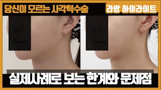 사각턱수술 실제사례를 통한 한계와 문제점 [당신이 모르는 사각턱수술 #2]