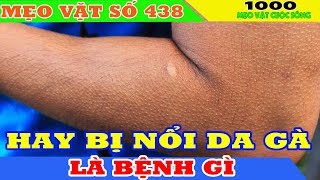 Hay bị nổi da gà là bệnh gì - Bị nổi da gà có gì nguy hiểm không? Giật mình khi biết thông tin này!