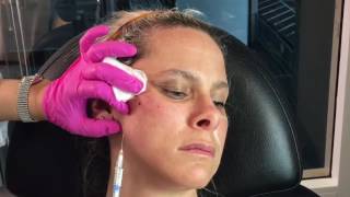 Liquid Facelift with Radiesse