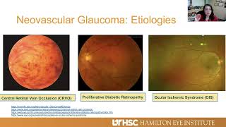 Lecture: Diagnosis and Management of Neovascular Glaucoma