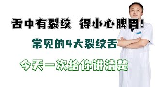 舌中有裂纹，得小心脾胃！常见的4大裂纹舌，今天一次给你讲清楚