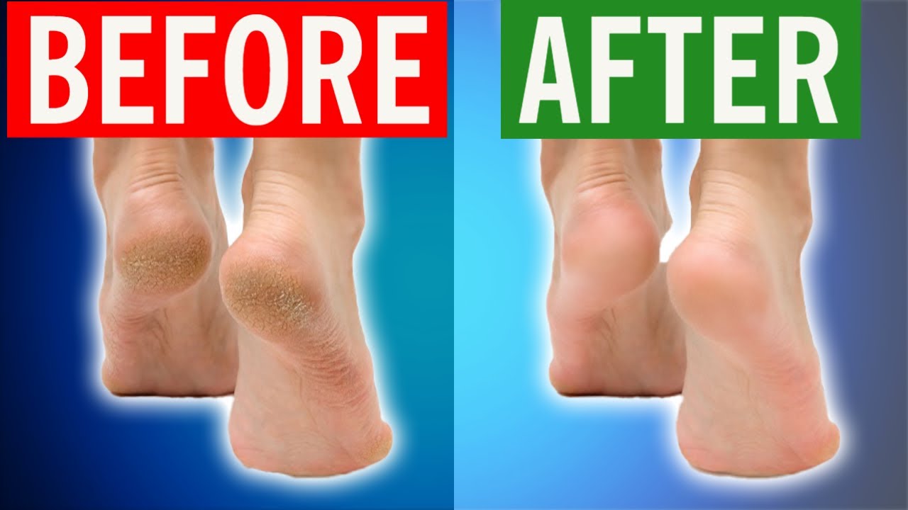 How To Fix Cracked Heels Permanently In 2024 - YouTube