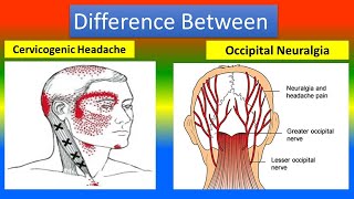 Difference Between Cervicogenic  and  occipital  Neuralgia