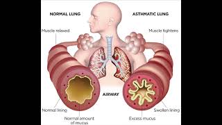 Escape the Vape - Asthma