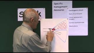 Shock 8, Management of Cardiogenic Shock