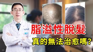 #脂溢性脫髮 被稱為脫髮中的＂癌癥”，真的無解嗎？