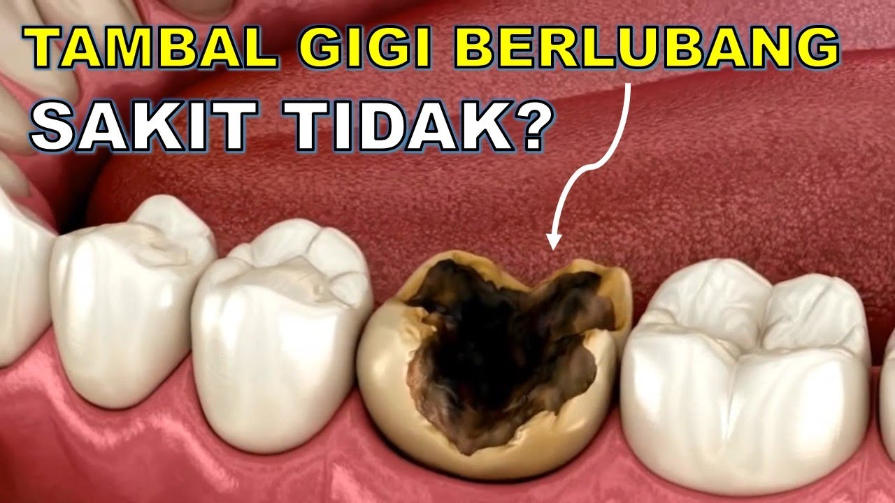 Tambal Gigi Berlubang Sakit Tidak 🙄 - YouTube