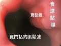 主題：一種新興的經由胃內視鏡灌注益生菌的臨床治療～頑固性胃食道逆流的益生菌灌注的輔助治療成效的探討與分享 操作者：譚健民醫師 20181020 。