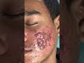 Black Peel Treatment For Acne | chemical peel for acne | acne treatment | Skinaa Clinic #shorts