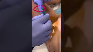 The FULL POP of this amazing abscess | 208SkinDoc