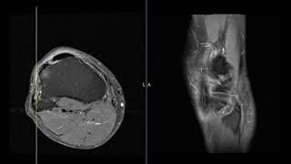 Lateral knee pain and tenderness in 65 year old runner