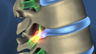 Percutaneous laser discectomy (laser back surgery)