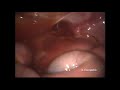 laparoscopic drainage of a large retroperitoneal abscess following perforated appendicitis