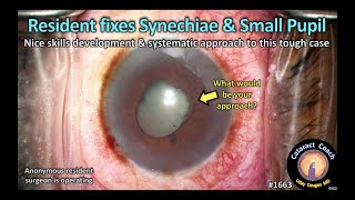 CataractCoach 1663: resident fixes synechiae and small pupil