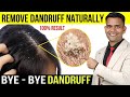 Get Rid of Dandruff Naturally at Home - Dr. Vivek Joshi