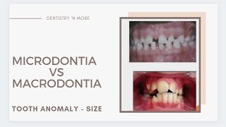 DEVELOPMENTAL DISTURBANCES OF TEETH - PART 1(SIZE)