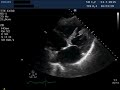 ventricular septal defect after acute myocardial infarction