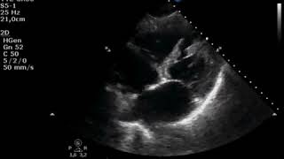 Ventricular Septal Defect after Acute Myocardial Infarction