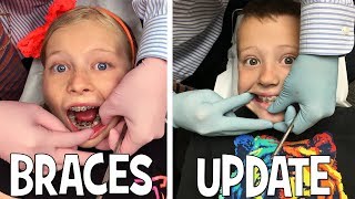 We Are Braces Twins!!