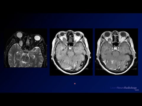 Neuroradiology Board Review - Brain Tumors - Case 19 - YouTube