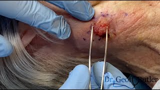 Removal of a Basal cancer on the neck