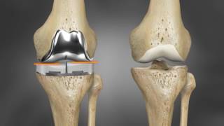 ConforMIS Knieimplantat: iTotal® G2 iFit® Technologie Animation