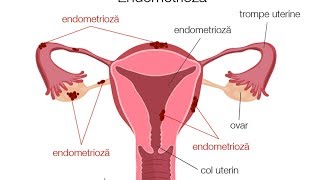 Endometrioza