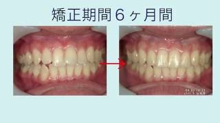 驚きの矯正期間６ヶ月　前歯の”部分矯正”