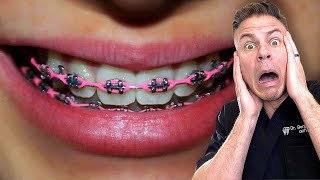 Dentist Reveals Why Power Chains ARE NOT For Looks!