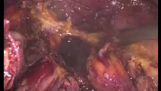 LAPAROSCOPIC DECORTICATION OF SUBCAPSULAR KIDNEY HEMATOMA (Page kidney)