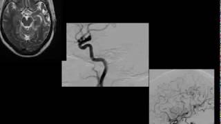 LEFT TEMPORAL AVM WITH PREVIOUS RUPTURE AND PARACLINOID ANEURYSM. USING THE DOLENC APPROACH.