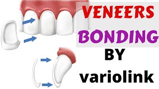 Veneers Bonding Cementation luting Protocol- variolink ivoclar n instructions and guide with steps