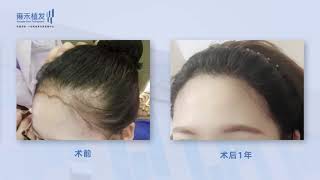 珠海女士lattice微針加密植髮種植效果展示分享Yonghe hair transplant