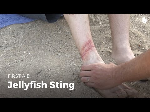 First Aid: Jellyfish Sting | First Aid First Aid: Jellyfish Sting | First Aid