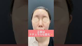 鼻中隔延長＋鼻尖形成3D法＋鼻尖部軟骨移植【形成外科専門医の鼻整形】