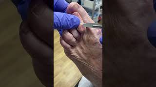 Expert 2nd Toe Callus and Corn Removal by Australian Podiatrist!