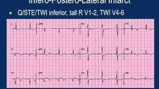 Susan Sallach M.D., F.A.C.C. 'EKG's - ST's and T waves'