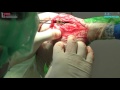 how to spread a tta osteotomy with the leibinger spreader