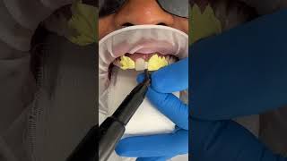Gap closure using composite veneers ✨🤍