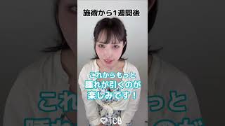 【糸リフト】あおりいな👼💎さん✨糸リフトの経過はいかに…⁉️ #shorts