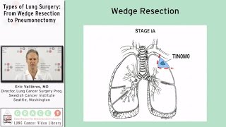 Types of Lung Surgery: From Wedge Resection to Pneumonectomy