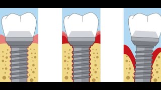 Peri implantitis