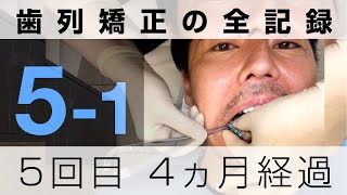 初めての色付きカラーゴム｜歯列矯正の全記録5-1