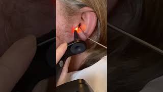 Ear wax removal on a patients blocked ear 👂🙌