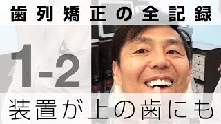 矯正装置（ブラケット）を上の歯にもつけます｜歯列矯正の全記録1-2