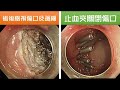 內視鏡黏膜下剝離術切除肝彎曲 hepatic flexure 四公分處大腸腫瘤