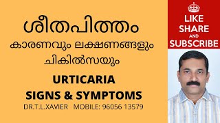 ശീതപിത്തം | How to Treat Urticaria? Signs Symptoms & Simple Tips. Dr T L Xavier